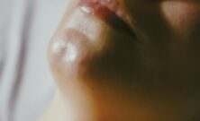 Effektiv rynkebehandling: Laser og injeksjoner