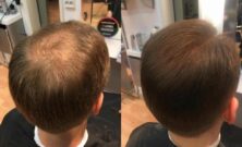 Parykk  en praktisk og trygg løsning ved hårtap