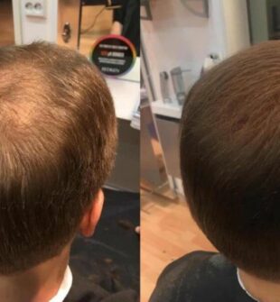 Parykk  en praktisk og trygg løsning ved hårtap