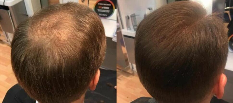 Parykk  en praktisk og trygg løsning ved hårtap